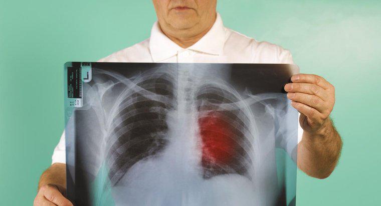 Quel est le pronostic du cancer du poumon de stade trois?