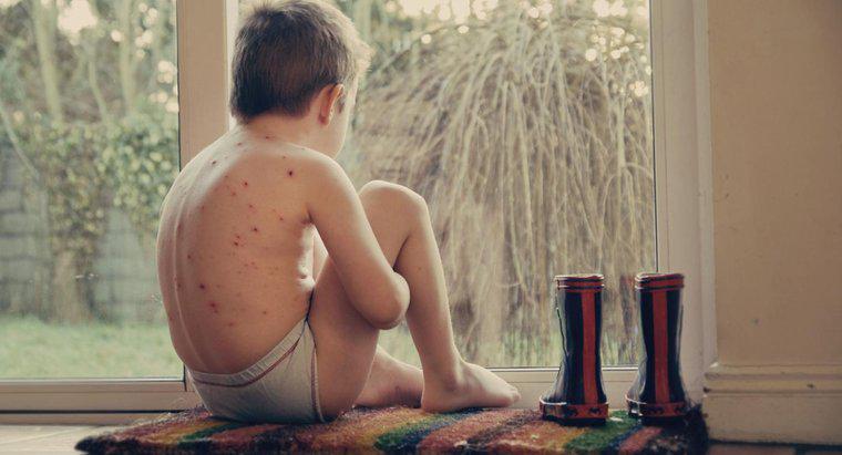 Quel est le cycle de vie de la varicelle ?