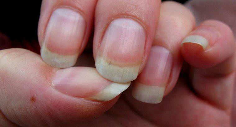 Quelles sont les causes des crêtes dans les ongles ?