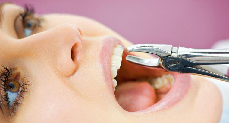 Combien de temps faut-il pour qu'une alvéole guérisse après l'extraction d'une dent ?