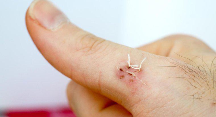 Que faire si les points de suture solubles ne se dissolvent pas ?