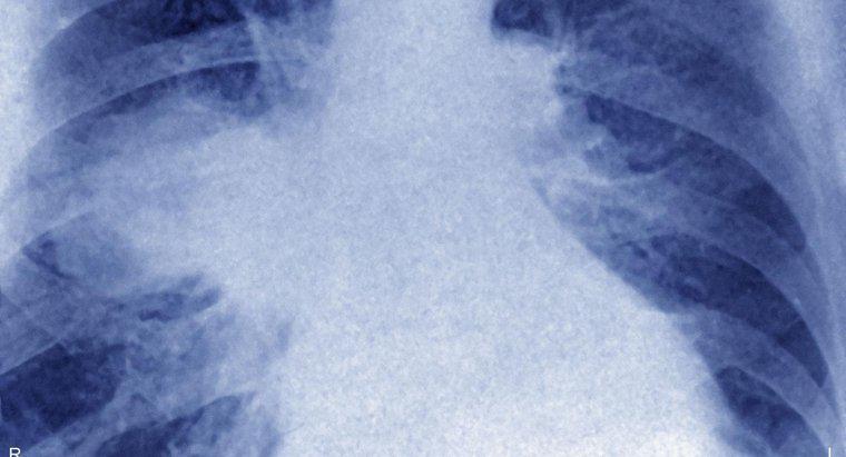 Qu'est-ce que le lymphome des poumons?