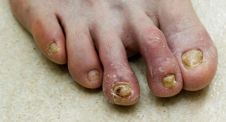 Quels sont les remèdes maison pour la mycose des ongles des pieds ?