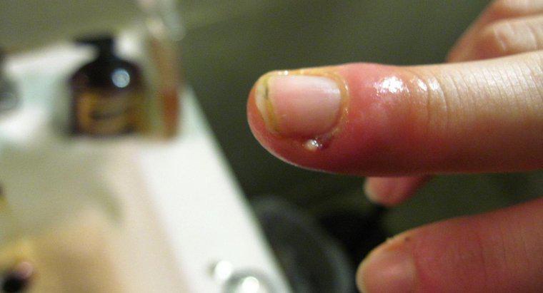 Que doit faire une personne avec un doigt enflé à la suite d'une infection des cuticules ?
