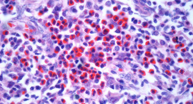 Qu'est-ce que le cancer du lymphome de stade 3?