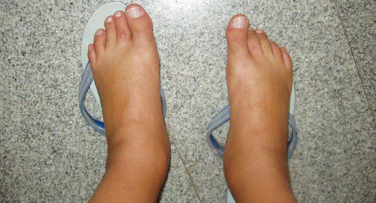 Quelles sont les causes des pieds enflés ?