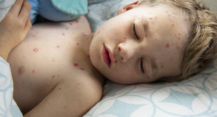 D'où vient la varicelle ?