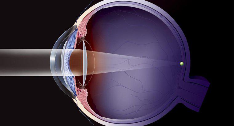 Quel est le temps de récupération standard après une chirurgie de la cataracte?