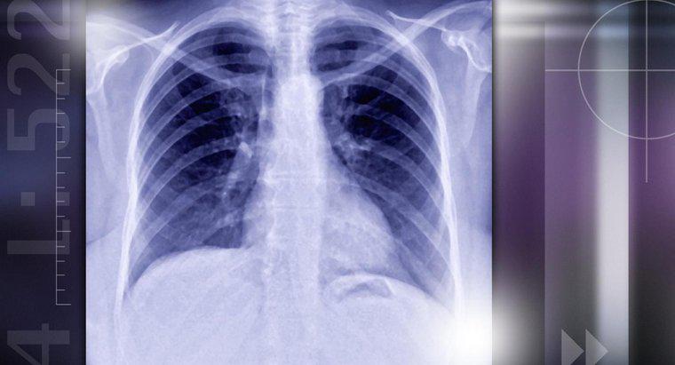 Quelles sont les causes des nodules pulmonaires?