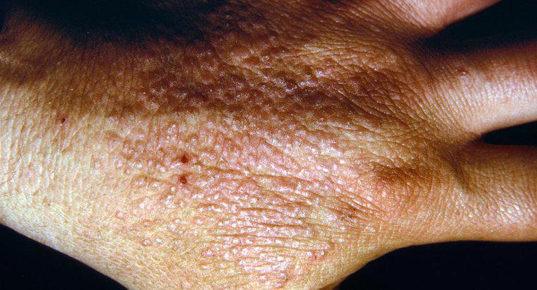 Comment les gens contactent-ils la dermatite?