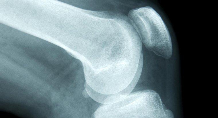 Quels sont les premiers symptômes du cancer des os ?