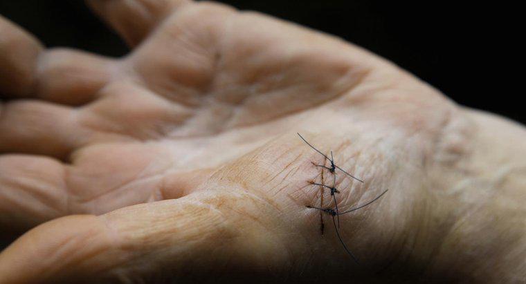 À quoi ressemblent les points de suture infectés ?