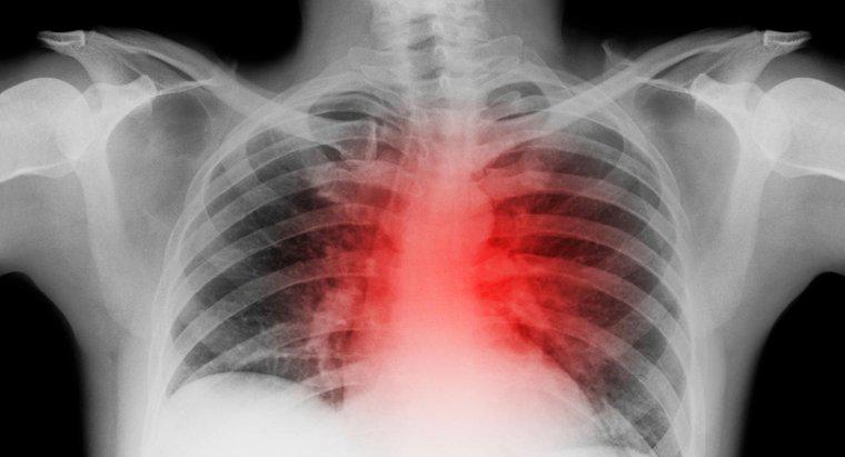 Qu'est-ce qu'une racine aortique dilatée?