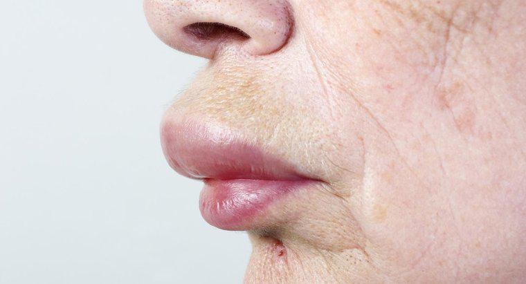 Comment soigner une lèvre et un visage enflés ?