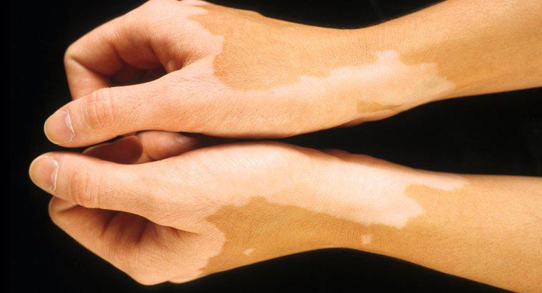 Quels sont les types de maladies de décoloration de la peau?
