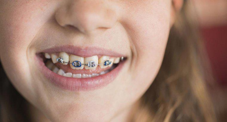 Comment savoir où acheter de faux appareils orthodontiques ?