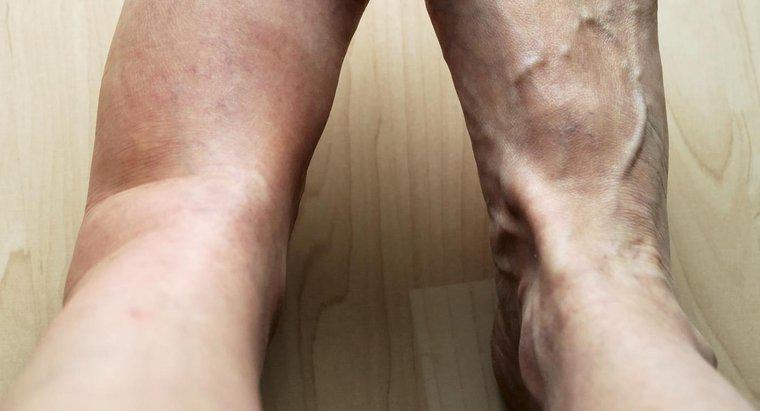 Quelles sont les causes possibles de la douleur et de l'enflure de votre jambe gauche ?