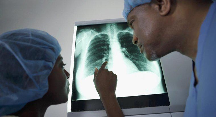 Que signifie une masse sur le poumon?