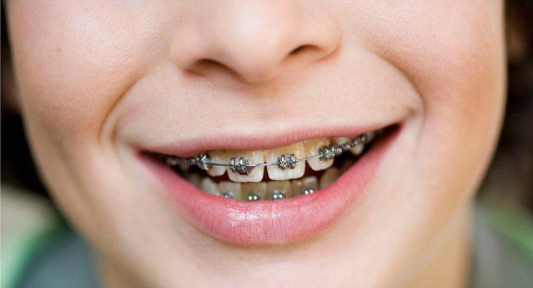 Comment les piercings à la langue affectent-ils les appareils dentaires?