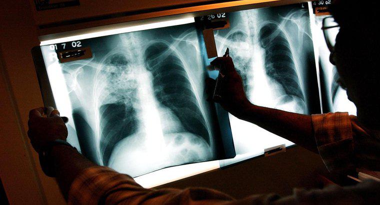 Quels sont les effets à long terme de la tuberculose ?