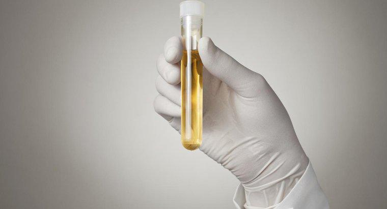 Qu'est-ce que cela signifie lorsque vous avez une teneur élevée en protéines dans votre urine ?