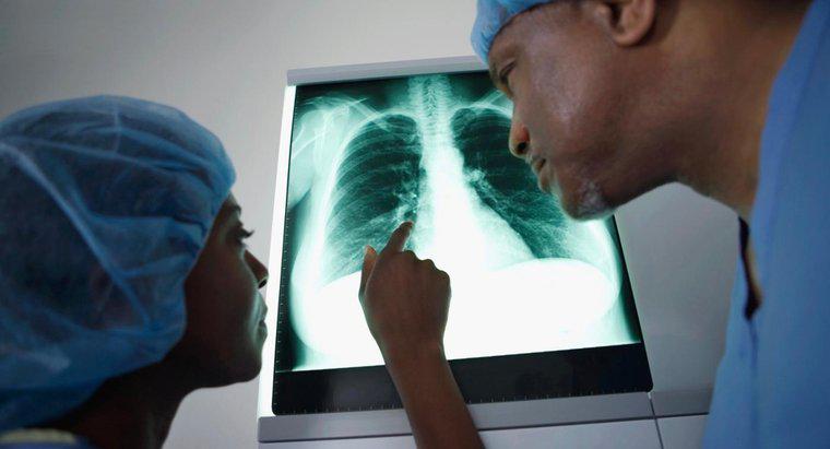Quels symptômes sont propres au cancer du poumon ?