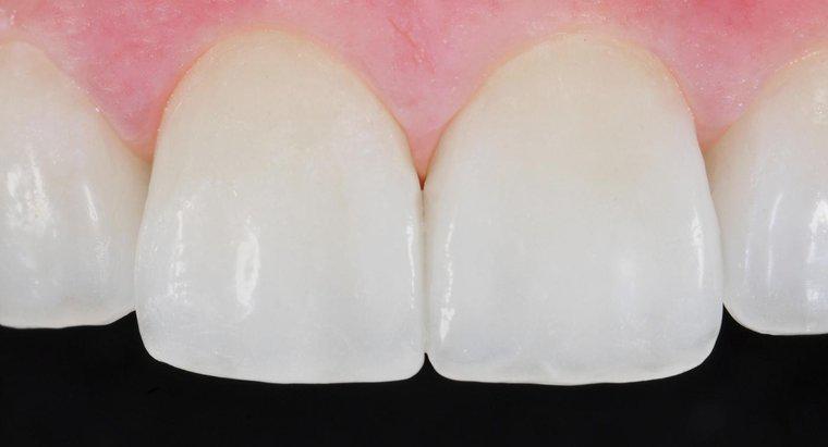 Les facettes dentaires sont-elles couvertes par l'assurance?