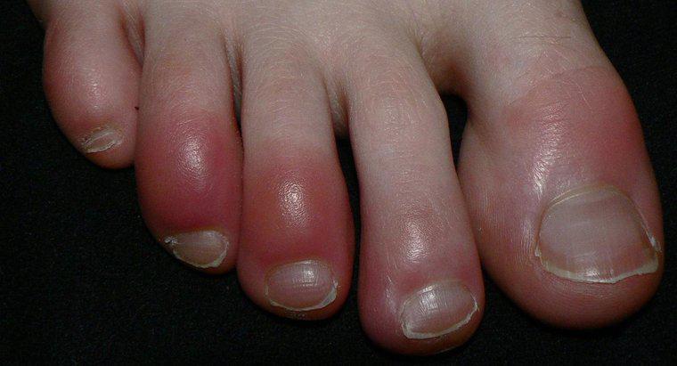 Les orteils rouges sont-ils un symptôme du syndrome de Raynaud ?