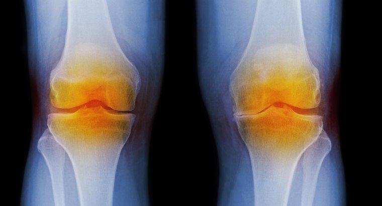 Quels sont les symptômes de l'arthrite au genou?