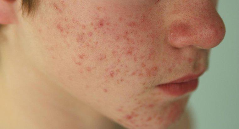 L'hypothyroïdie provoque-t-elle l'acné ?