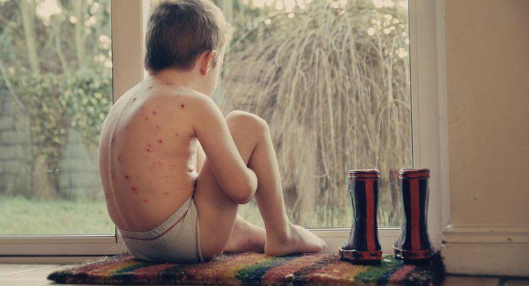 Quelle partie du corps la varicelle affecte-t-elle?