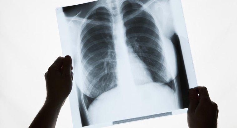 Quelles sont les causes des taches blanches dans les poumons ?