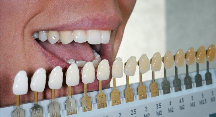 Les fausses dents peuvent-elles être blanchies ?