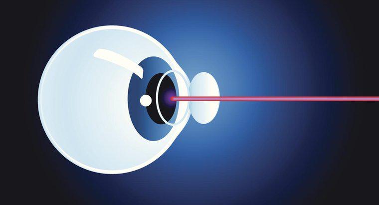 Qu'est-ce que la chirurgie de la cataracte au laser?