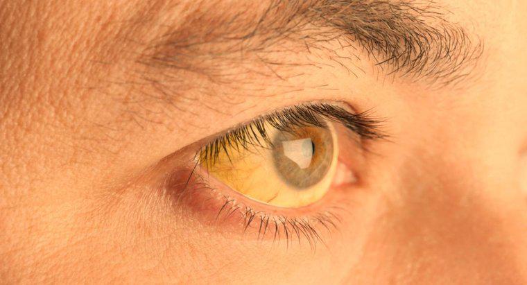 Qu'est-ce qui fait jaunir la peau sous les yeux ?
