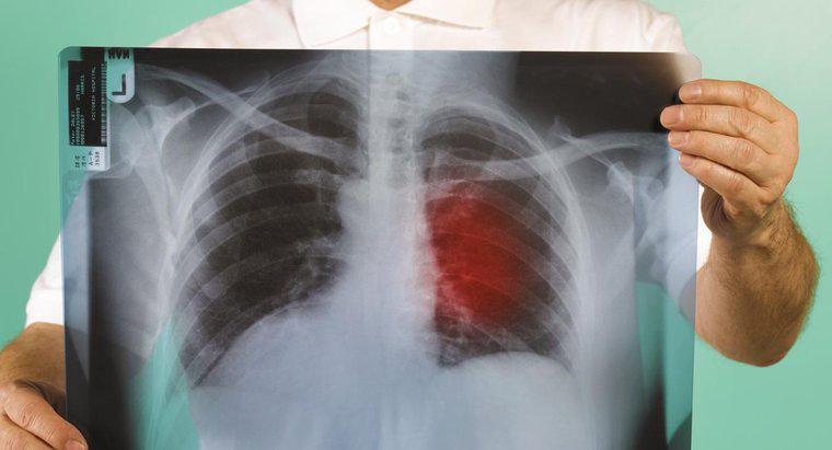 Quels sont les premiers signes du cancer du poumon ?