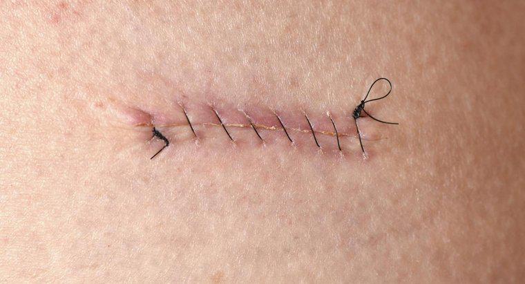 Combien de temps faut-il laisser les points de suture ?
