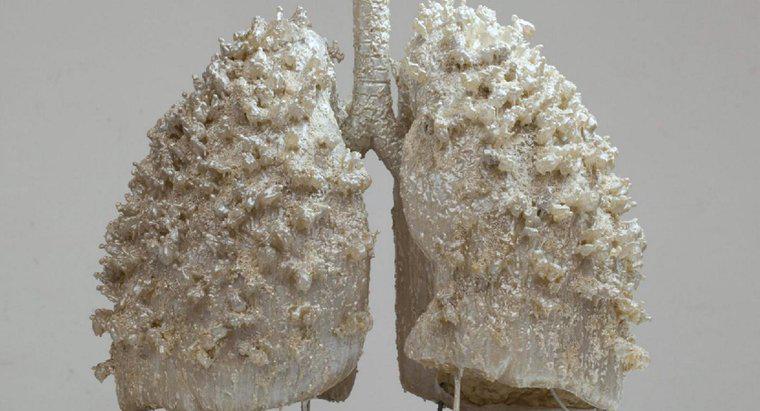 Une personne peut-elle vivre avec un seul poumon ?