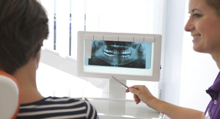Combien dois-je m'attendre à payer pour les implants dentaires ?