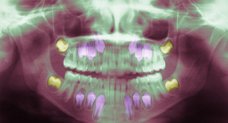 Quelles sont les causes d'une infection des dents de sagesse?